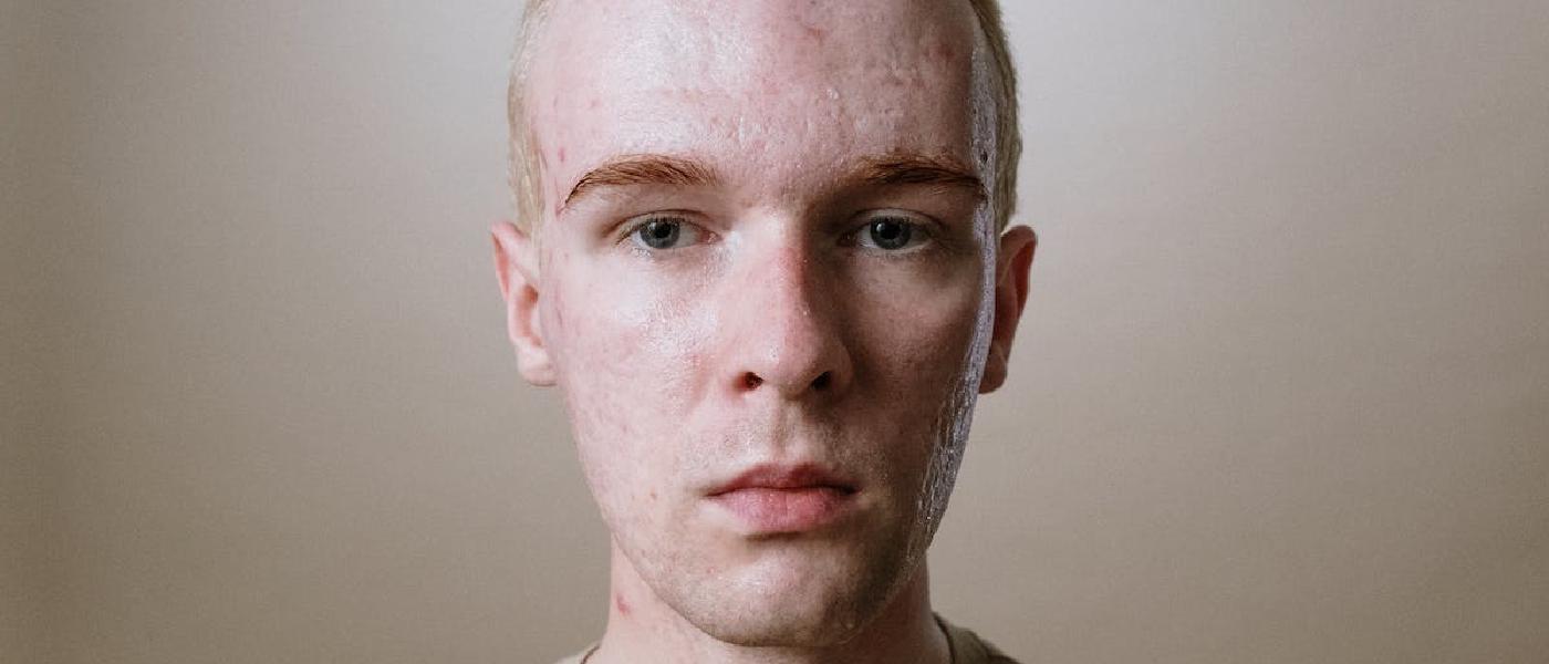 Come prevenire e trattare l'acne